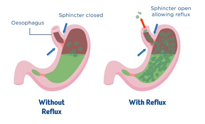 Image of stomach when reflux occurs and when there is no reflux